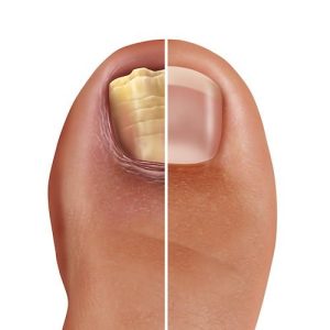 Geven tumor voordeel De beste tips voor behandelen van schimmelnagels ofwel kalknagels