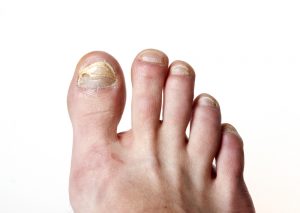 hypothese Reusachtig Besmettelijke ziekte De meest gestelde vragen over schimmelnagels - Pedicure beantwoord